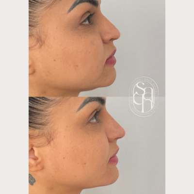liquid rhinoplasty nose filler chin filler for profile balancing with juvederm voluma restylane botox