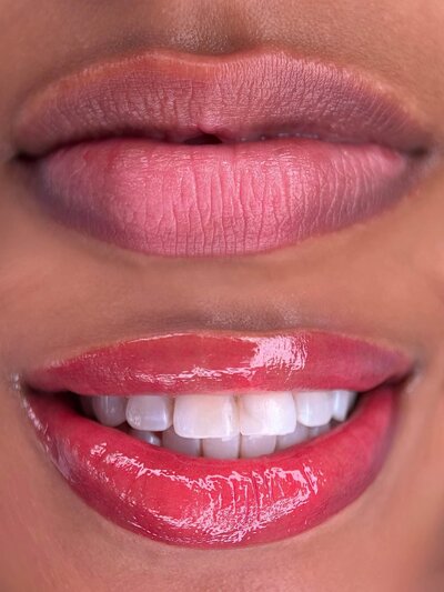 Lip Neutralization new york