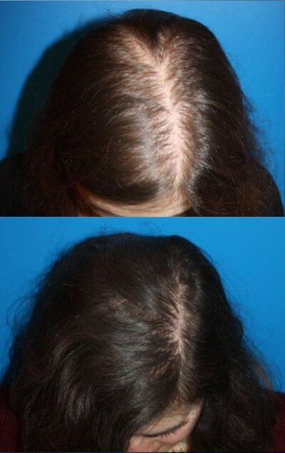Before and after image showing hair restoration results from PRP Therapy at Refined Medical NY. Platelet-rich plasma treatments stimulate hair growth and improve hair density for patients experiencing hair thinning or hair loss.