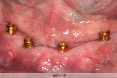 implant denture before