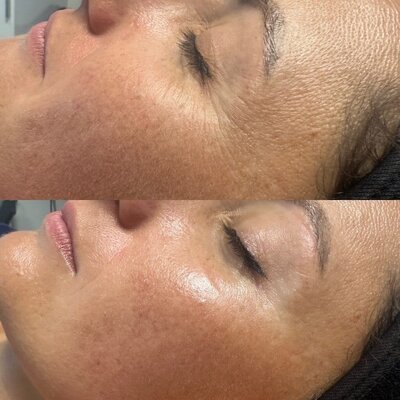 avant après du jet peel