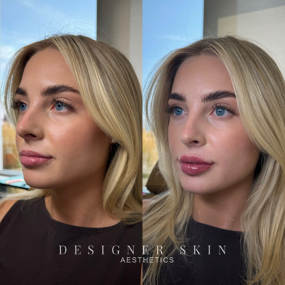 Before and after lip filler treatment in Huntington Beach