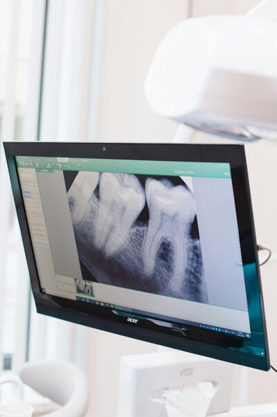 An x-ray of a root canal or tooth with a cavity or decay.