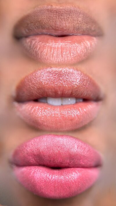 Dark Lip Neutralization Nyc