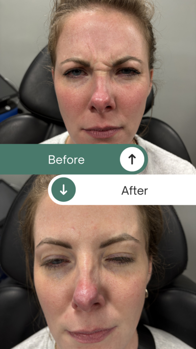 Botox1