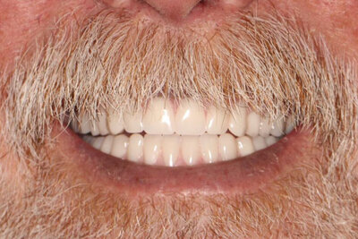 implant denture
