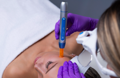 dark spots treatment | microneedling | skincare | facials | glowing skin | professional | dermalogica | clear skin | hydrafacial | hydrating |  beauty | leicester | oadby