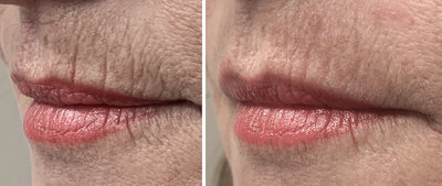 Lipfillers door cosmetisch arts Lizenka Adriaanse in Rotterdam