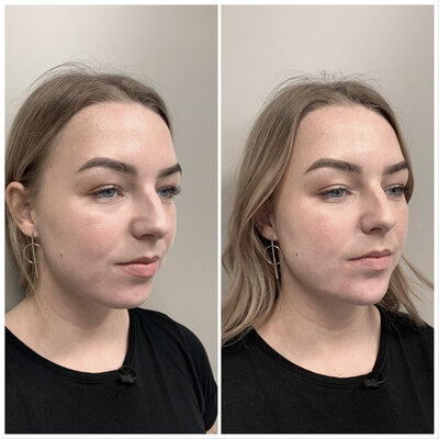 Liquid facelift kaaklijn Lizenka Adriaanse cosmetisch arts Rotterdam