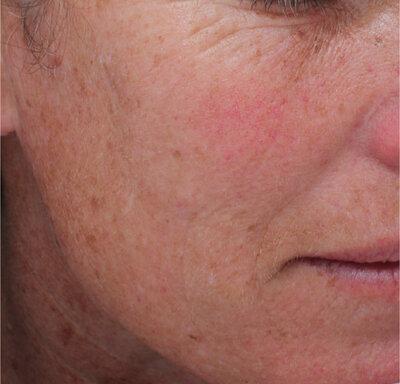 Beauty and Grace Aesthetics Botox patient before and after