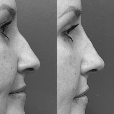 Non-surgical nose contouring using dermal filler at Luna Skin, esthetician in College Station TX