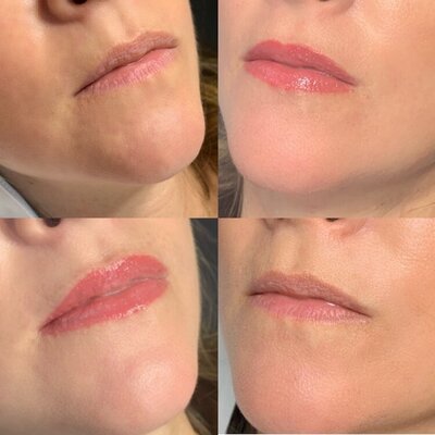 Lip Blush results at Refresh Aesthetics
