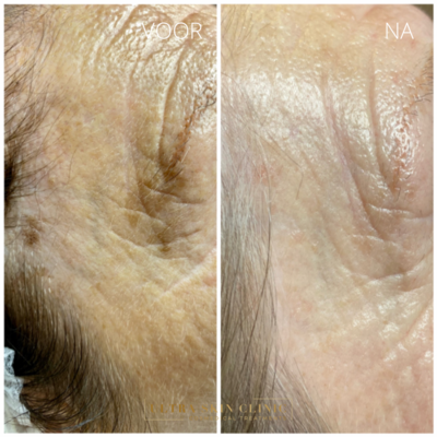 Verwijderen ouderdomswrat en ouderdomsvlek ultra skin clinic