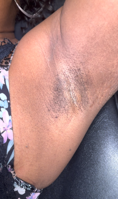 Before underarm waxing with visible hair at Jazzy's Glam Bar in Tampa, FL.