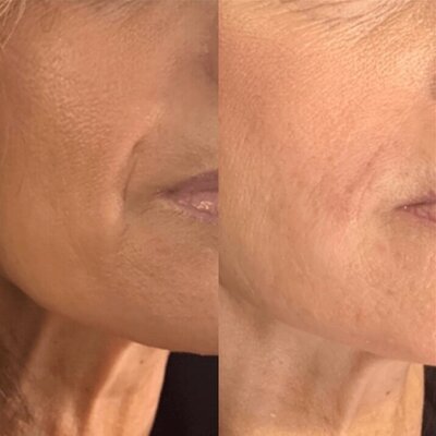 Dermal filler results from a procedure at Refresh Aesthetics