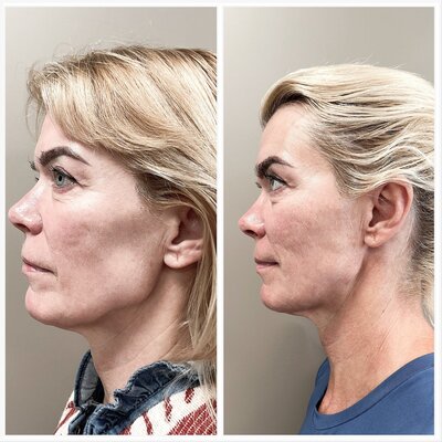Liquid facelift Lizenka Adriaanse cosmetisch arts Rotterdam