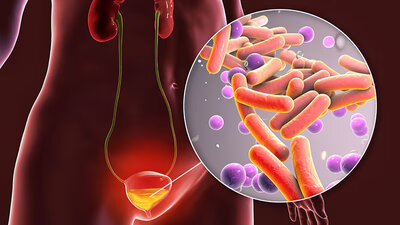 Urinary Tract Infections