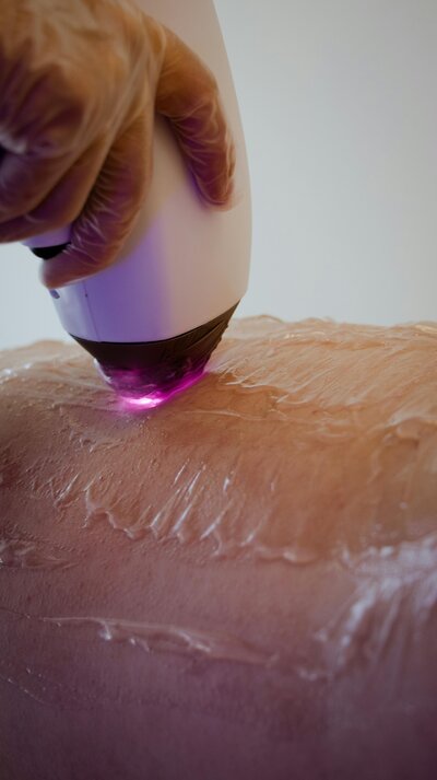 Photo d'un laser pour une épilation définitive
