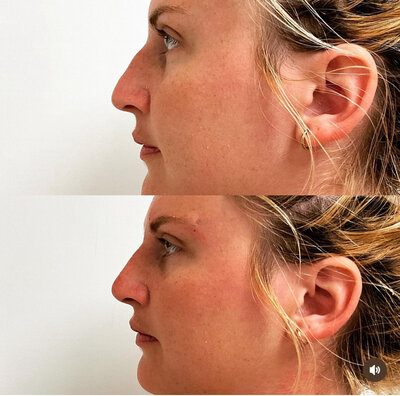 Before and after image showing non-surgical Liquid Rhinoplasty results using dermal fillers at Refined Medical NY. This treatment reshapes and enhances the nose without surgery for a smoother, more balanced profile.