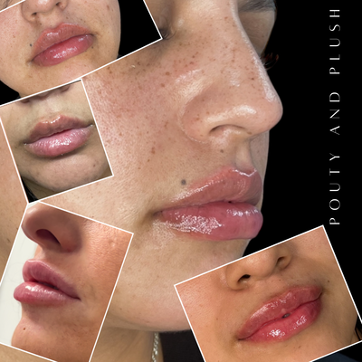 Lip injections before and after photo

