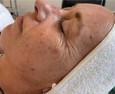 avant après du jet peel