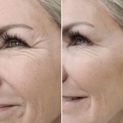 Botox before after door Lizenka Adriaanse cosmetisch arts Rotterdam