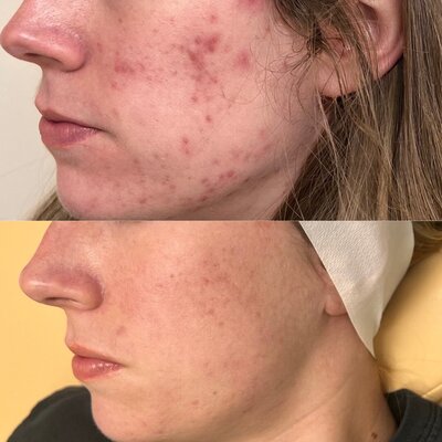 Perfect derma peel, acne peel, chemical peel in barrington IL. Peels help with pigmentation, acne, scarring and more.