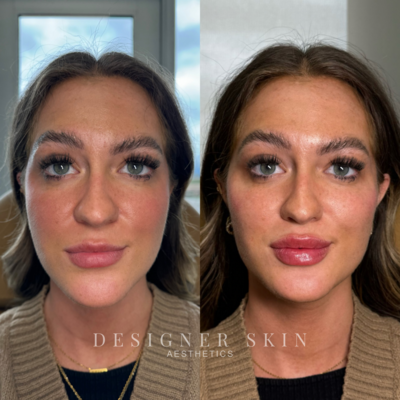 Before and after lip filler treatment in Huntington Beach