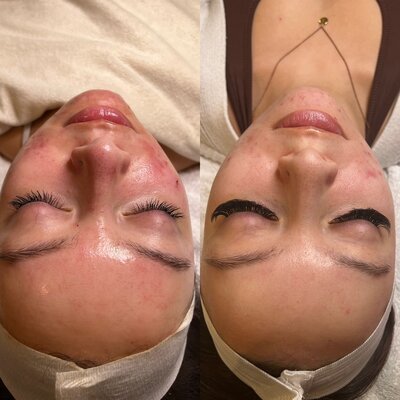 acne treatment 1 session