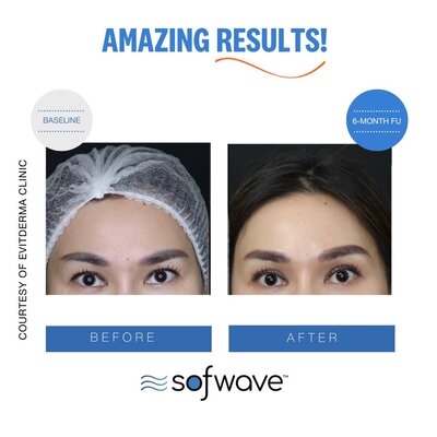 Set-50-Eyebrow-Skin-Type-4