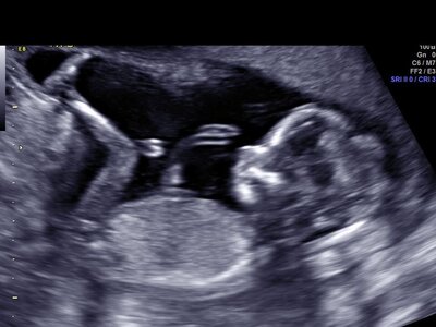 Close up of Baby's face in 3D Ultrasound Image