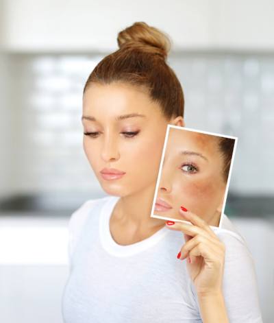 woman wearing a white shirt who healed her melasma holding a photo of herself from when she had melasma