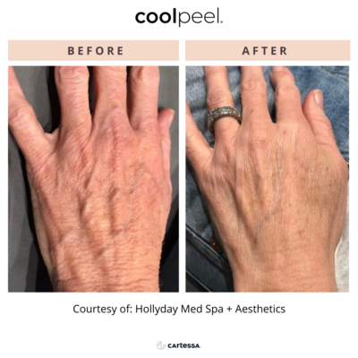 CoolPeel before and after photo hands