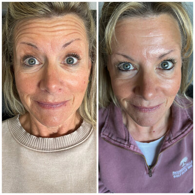 Before and after of womans face before and after Botox