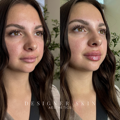 Before and after lip filler treatment in Huntington Beach