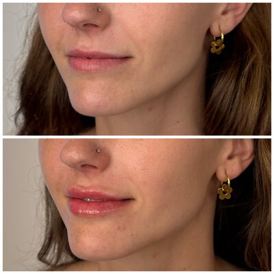 lips before and after