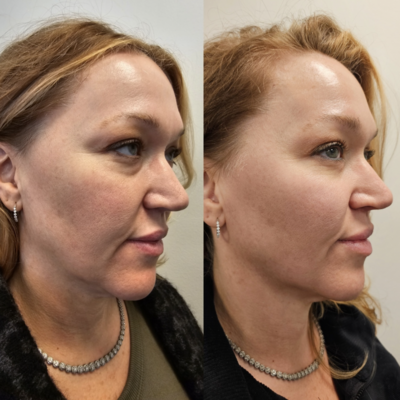 Upper and lower face neurotoxin results

