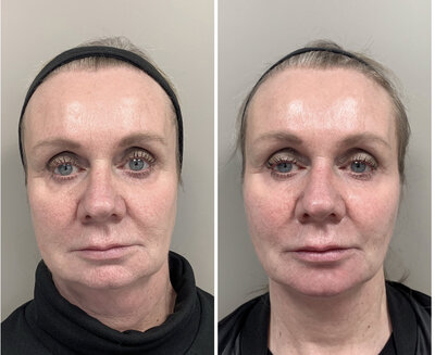 Before after liquid facelift Lizenka Adriaanse cosmetisch arts Rotterdam