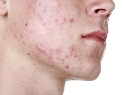 acne ultra skin clinic