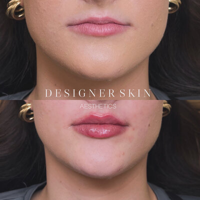 Before and after lip filler treatment in Huntington Beach
