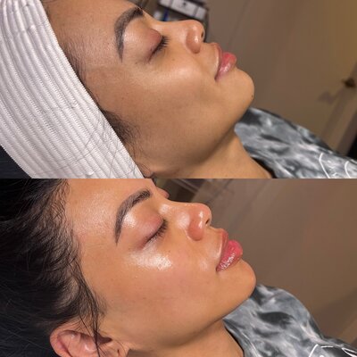 dermaplane treatment