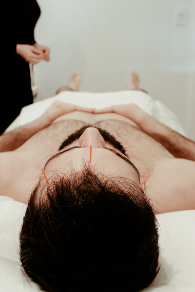 Male patient with dark hair has three acupuncture needles at the top of his forehead