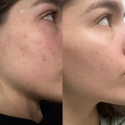 acne client 1 treatment