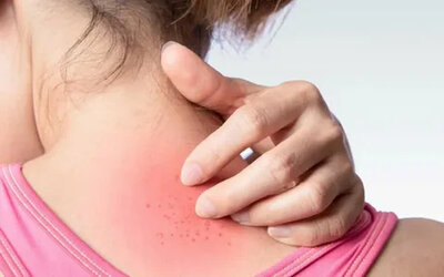Rashes