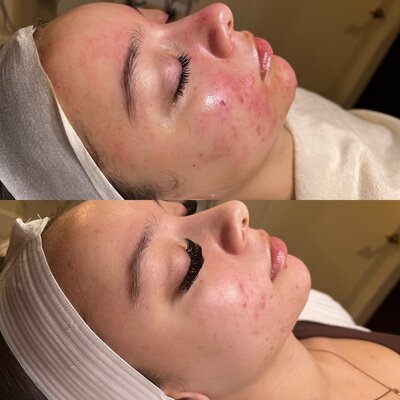 acne treatment 1 session.2