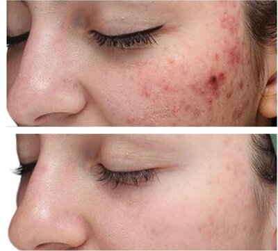 Before and after image showcasing the results of the VI Peel: Precision Plus at Refined Medical NY. This treatment helps improve skin tone, texture, and pigmentation, revealing brighter, smoother skin.