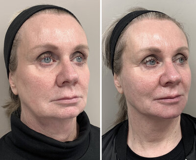 Before after liquid facelift Lizenka Adriaanse cosmetisch arts Rotterdam