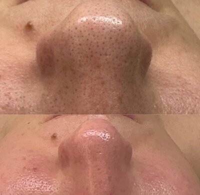 Hydrafacial before and after