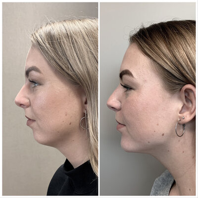 Liquid facelift kaaklijn Lizenka Adriaanse cosmetisch arts Rotterdam