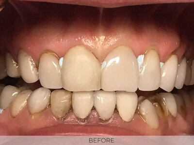 veneers